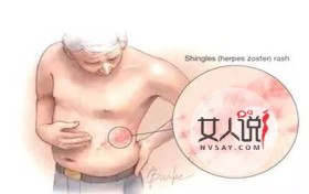 带状疱疹会传染吗，什么是带状疱疹