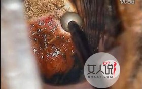 如何治疗宫颈糜烂 得了宫颈糜烂怎么办