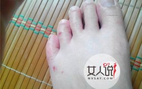 如何治疗脚气 治疗脚气的好方法推荐