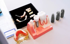 宁波种牙哪家医院好，宁波鼎植口腔医院口碑更好